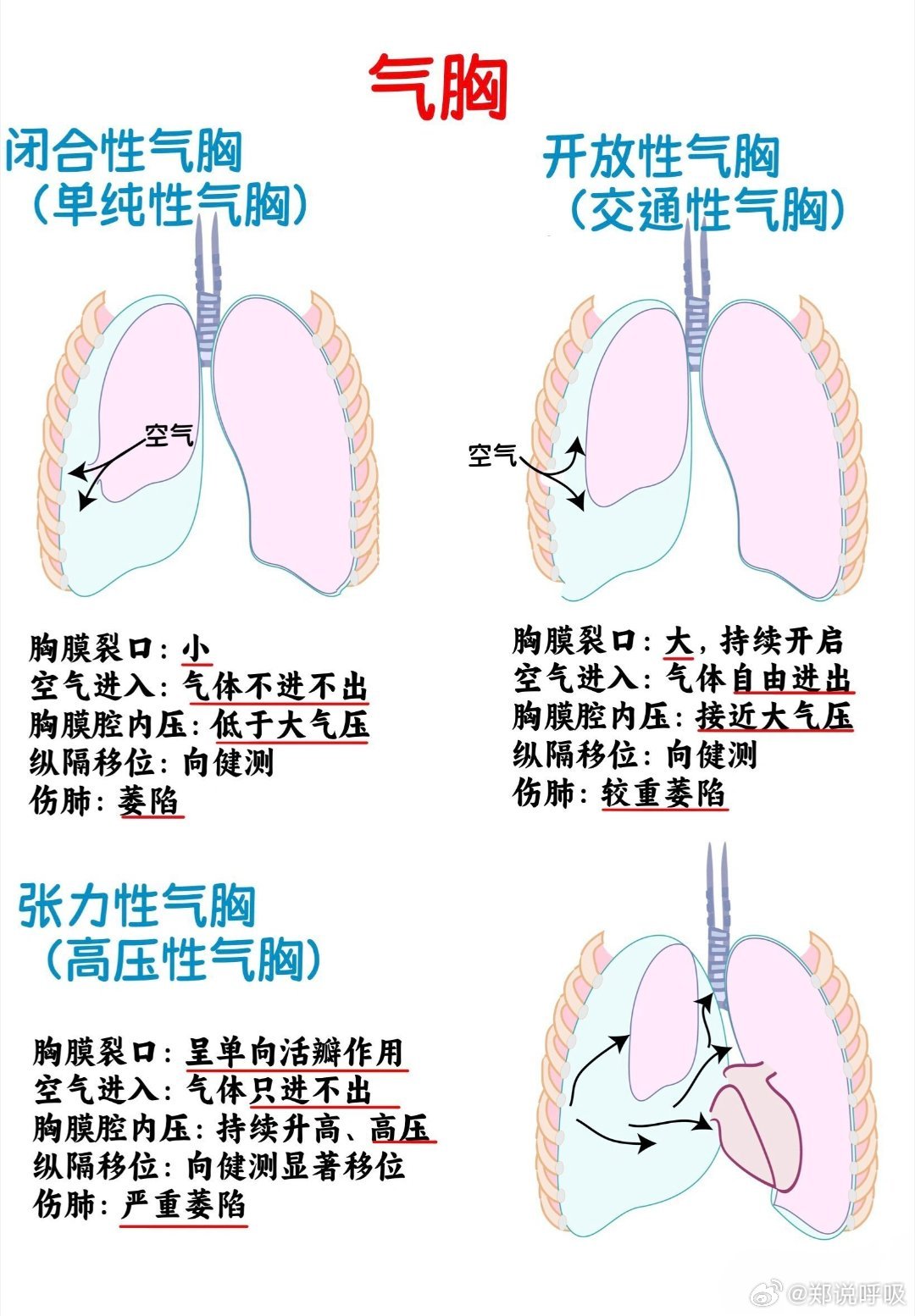 气胸简介，了解气胸及其成因